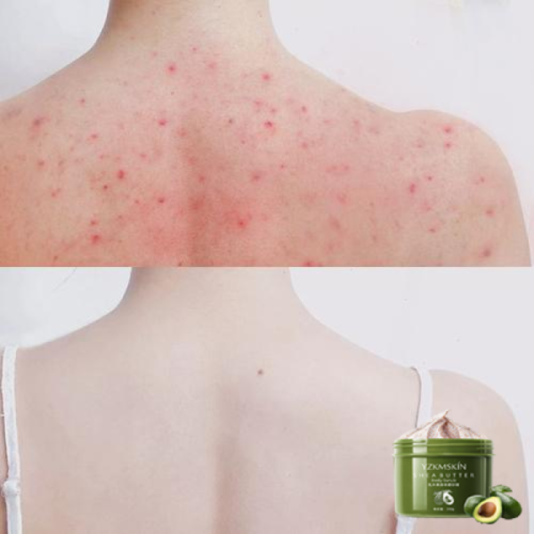 Kem tẩy tế bào chết cơ thể từ bơ hạt mỡ tự nhiên dưỡng ẩm làm trắng da tẩy tế bào chết tự nhiên 250g tẩy tế bào chết cơ thể làm sạch lỗ chân lông trên da loại bỏ sự tích tụ của lớp sừng trên da gà loại bỏ viêm chân lông